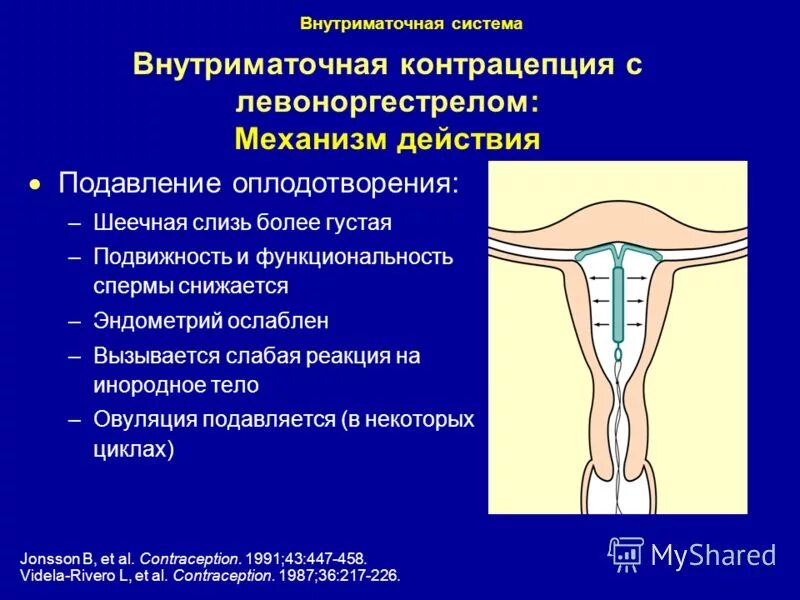 Спираль от беременности минусы. Внутриматочная контрацепция механизм. Внутриматочная спираль механизм действия. Внутриматочная контрацепция классификация. Механизм действия ВМС спирали.