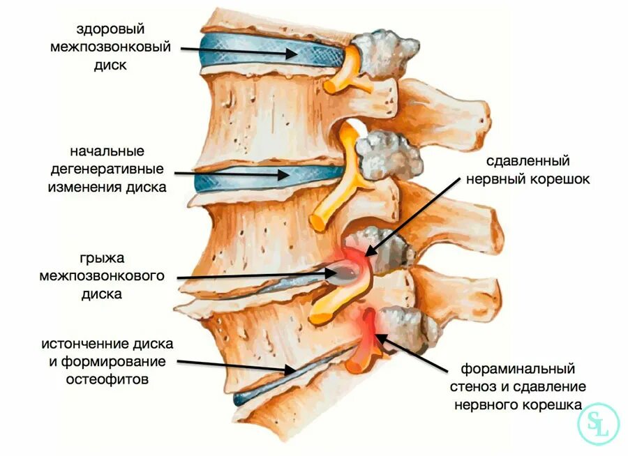 Содержимое межпозвоночного диска. Грыжа межпозвонквого дискапозвонок. Остеохондроз протрузии межпозвонковых дисков. Грыжа позвоночника поясничного отдела дисксковая. Анатомия Корешков поясничного отдела позвоночника.