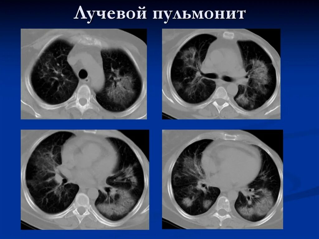 Травматический пульмонит кт. Постлучевой пневмофиброз кт. Постлучевой пневмонит на кт.