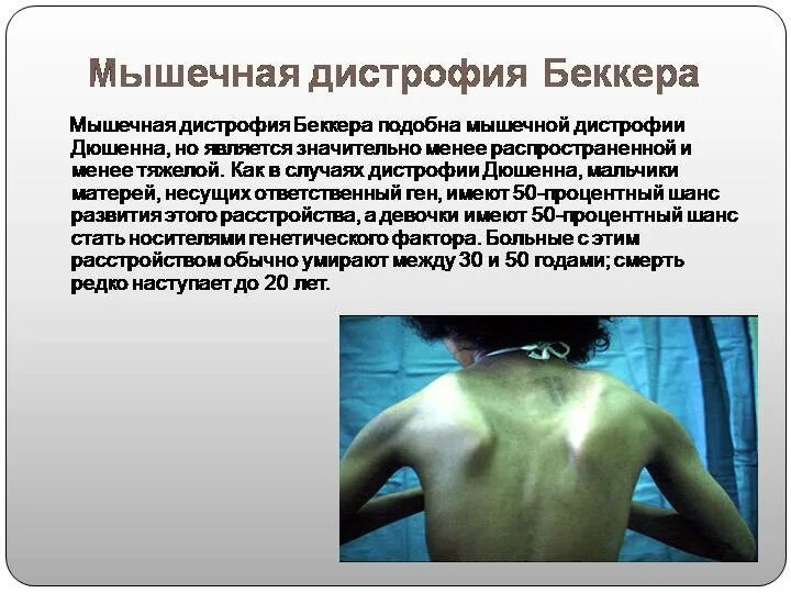 Мышечная дистрофия у детей симптомы. Миодистрофии дюшенна и беккера. мышечная дистрофия беккера. мышечная дистрофия дюшенна беккера. мышечная дистрофия миопатия.