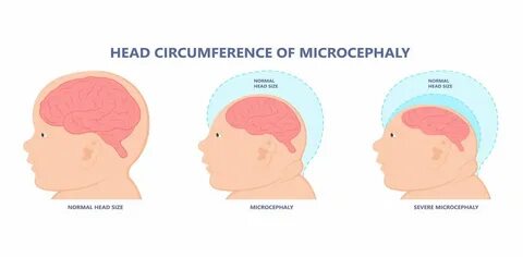 Микроцефалия умственная отсталость
