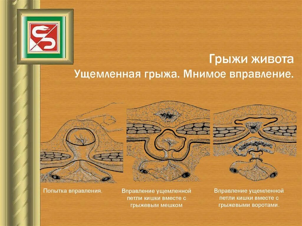 Грыжи передней брюшной стенки у детей презентация. Грыжа живота классификация. Классификация ущемленных грыж. Ущемление грыжи классификация.