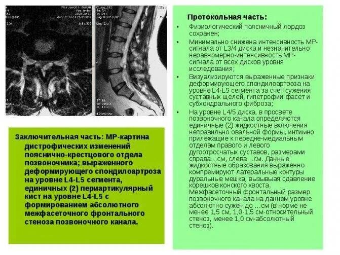 Крестцовый стеноз. Дегенеративный спинальный стеноз l3-l4. Сагиттальный размер позвоночного канала l3/l4 норма. Передне-задний размер позвоночного канала 9 мм. Стеноз позвоночного канала поясничного отдела мрт.