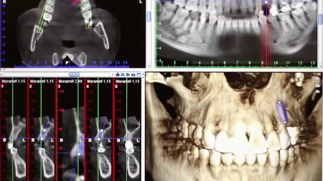 Можно ли с зубным имплантом делать мрт. Кт 15х15 верхней и нижней челюсти. Кт 3d верхней и нижней челюсти. Кт верхней челюсти и нижней челюсти.