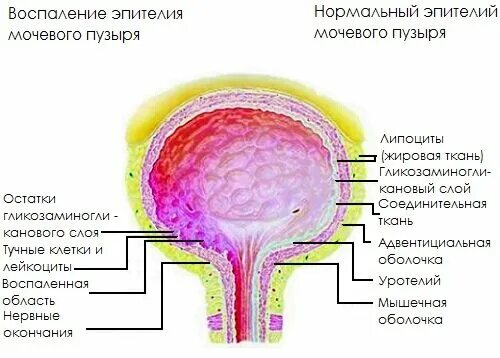 Диффузный мочевой пузырь. Подслизистый слой мочевого пузыря. Мышечные слои мочевого пузыря.