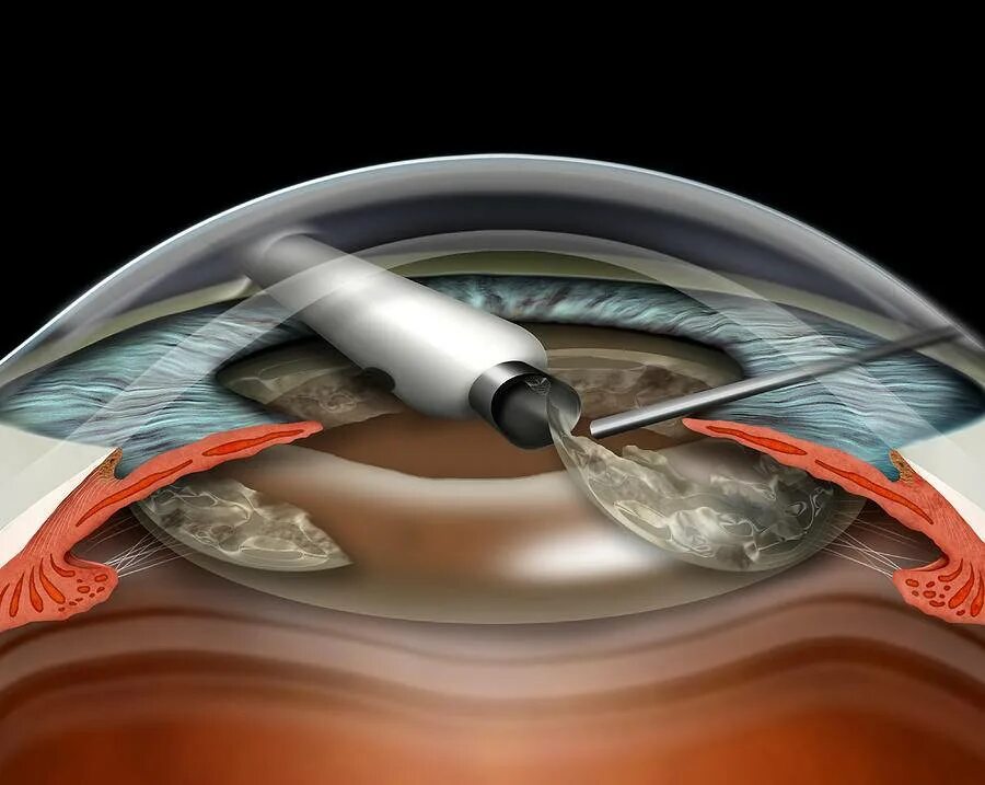 Замена хрусталика глаза как проходит операция. Катаракта факоэмульсификация. Операция ультразвуковая факоэмульсификация катаракты. Факоэмульсификация катаракты этапы операции. Факоэмульсификация с имплантацией ИОЛ.