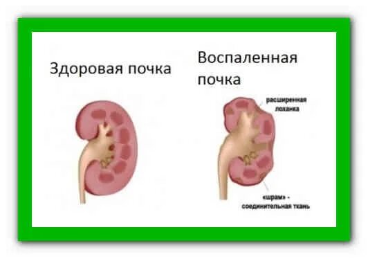 Может ли болеть одна почка. Если болят почки. Боль в почках препараты.