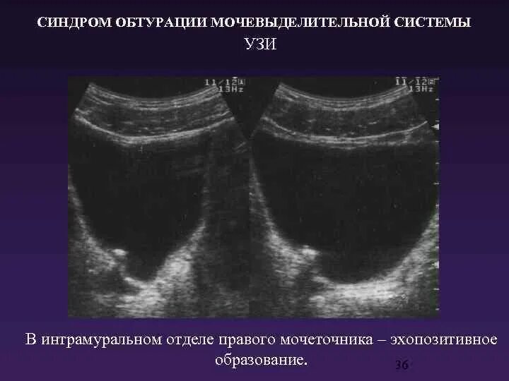 Интрамуральный мочеточник. Интрамуральный отдел мочеточника кт. Лучевое исследование органов мочевыделительной системы. Интрамуральный отдел мочеточника на УЗИ.