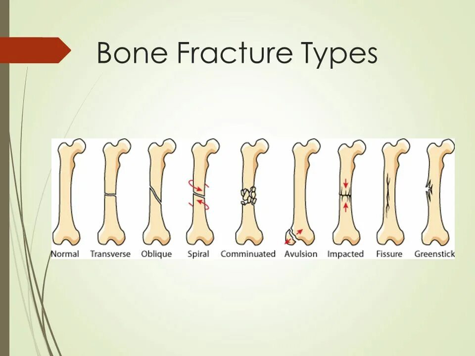 Перелом кости может быть каким. Перелом кости на латинском.