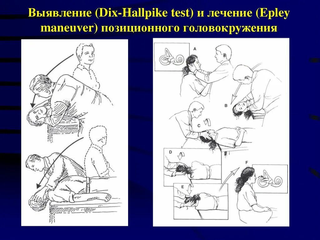 Проба холпайка. Проба Дикса-Холпайка. Позиционная проба вестибулярная. Проба Дикса-Холпайка и маневр Эпли. Позиционные пробы при головокружении.