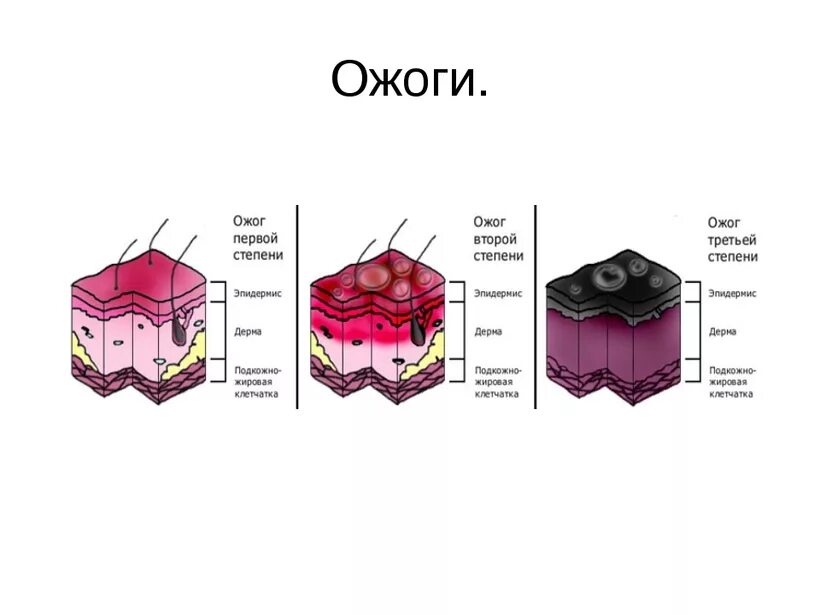 После того как сгорел. Солнечные ожоги 1 и 2 степени. Сильный ожог Солнечный 3 степени. Солнечный ожог 2 и 3 степени. Солнечный ожог 1 степени.