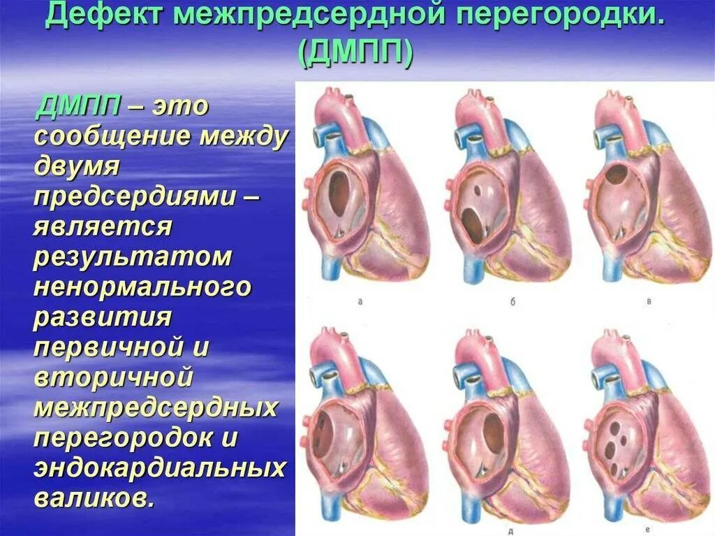 Аневризма перегородки у ребенка. Пороки межпредсердной перегородки ЭХОКГ. Порок сердца межпредсердной перегородки. Дефект межпредсердной перегородки Центральный. Сетчатый дефект межпредсердной перегородки.