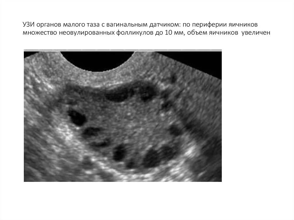 УЗИ яичников доминантный фолликул. Поликистоз яичников УЗИ малого таза. Синдром поликистозных яичников УЗИ.