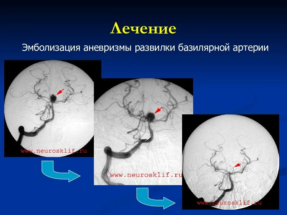 Эндоваскулярная эмболизация аневризм сосудов головного мозга.. Аневризма базилярной артерии кт. Аневризма головного мозга симптомы. Аневризма артерии головного мозга.