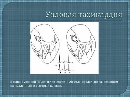 Узловая тахикардия