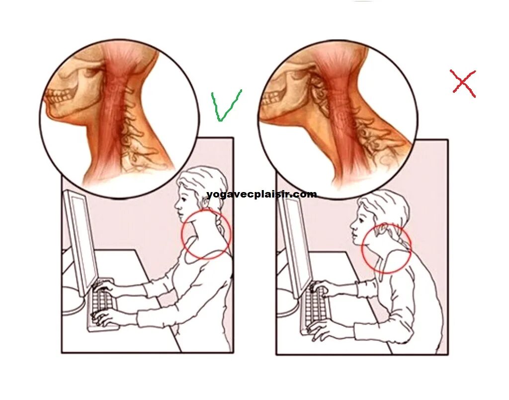 Больно поворачивать голову. Правильное положение шейного отдела позвоночника. Неправильное положение шеи. Неправильное положение головы.