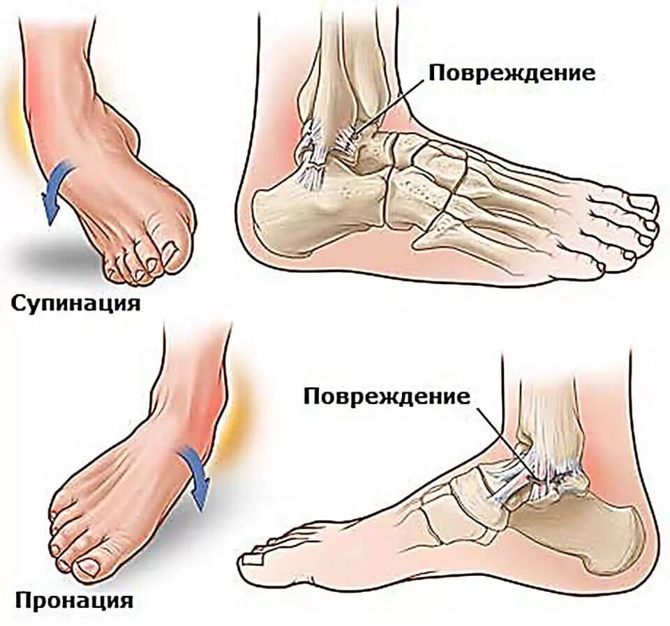 Боль ноги в голеностопном суставе. Супинация и пронация голеностопного сустава. Перелом с вывихом голеностопного сустава. Пронация супинация в голеностопе.