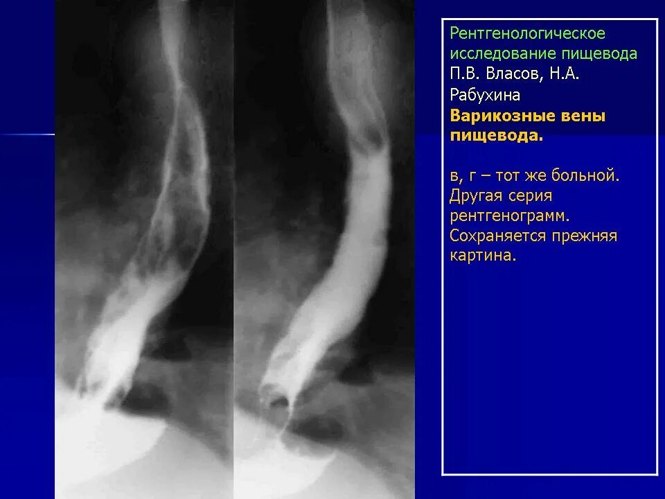 Второй пищевод. ВРВП -варикозное расширение вен пищевода. Варикозное расширение вен пищевода рентген описание. Варикозно расширенные вены пищевода ФГДС. Варикозное расширение пищевод рентген.