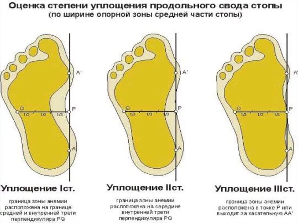 Средняя стопа. Оценка поперечного свода стопы. Продольное плоскостопие - уплощение продольного свода стопы. Оценка продольного свода стопы. Оценка степени уплощения поперечного свода.