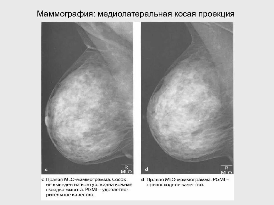 Маммография ростов на дону. Медиолатеральная проекция маммография. Косая проекция маммография. Косая проекция молочной железы. Маммография в косой проекции.