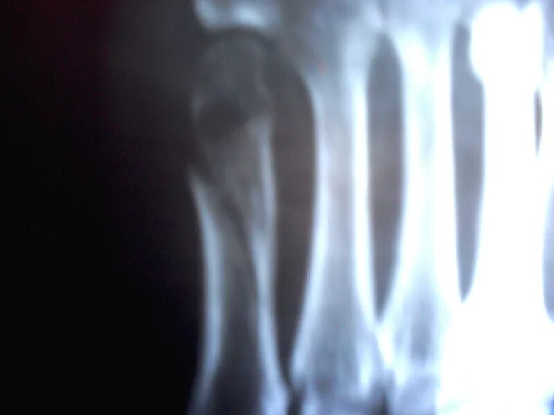 Трещина 5. Перелом плюсневой кости рентген. Перелом 5 плюсневой кости. 5 Плюсневая кость стопы перелом. Диафиза 5 плюсневой кости стопы.