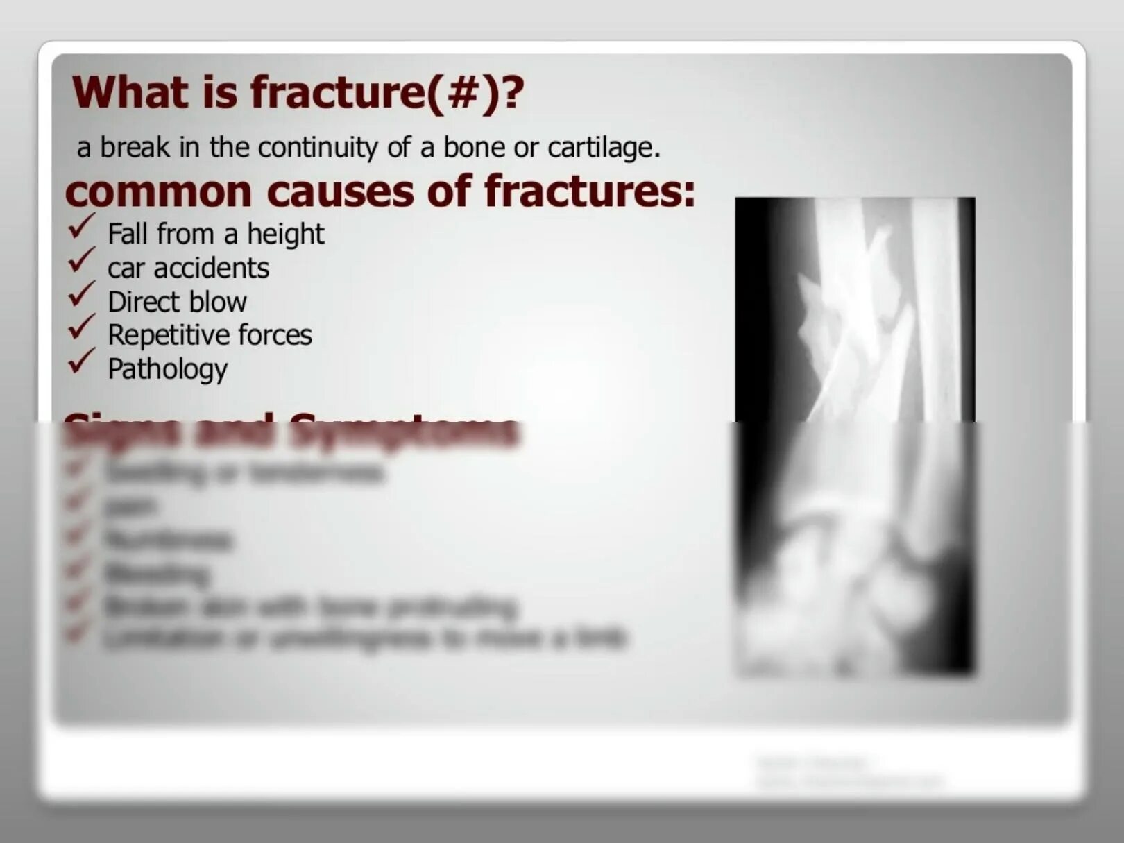 The fracture can be. The fracture can be