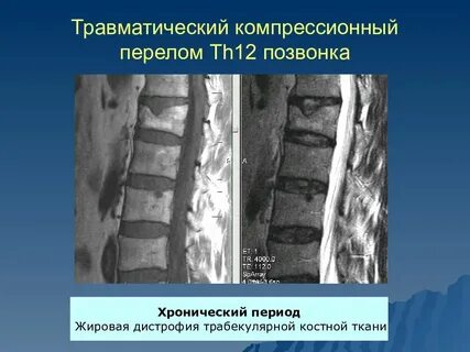 Компрессионный перелом 7
