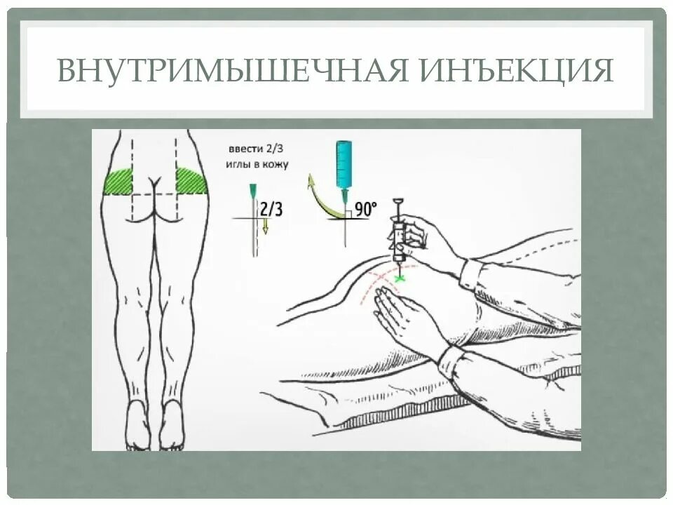 Назначение инъекций. Схема внутримышечных инъекций масляных растворов. Внутримышечная инъекция алгоритм. Введение внутримышечной инъекции в ягодицу алгоритм. Внутримышечная инъекция глубина введения иглы.