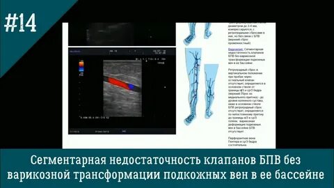 Варикозная трансформация притоков бпв