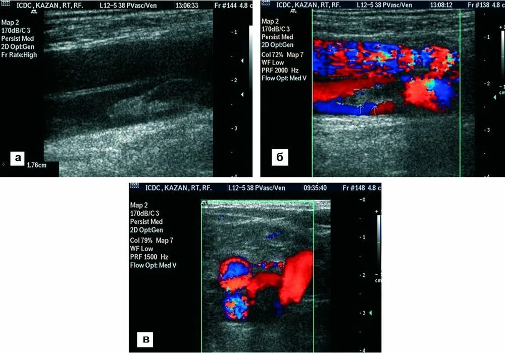 Тромбоз нижней полой вены на кт. Тромб нижней полой вены УЗИ. Узи вен тромбоз