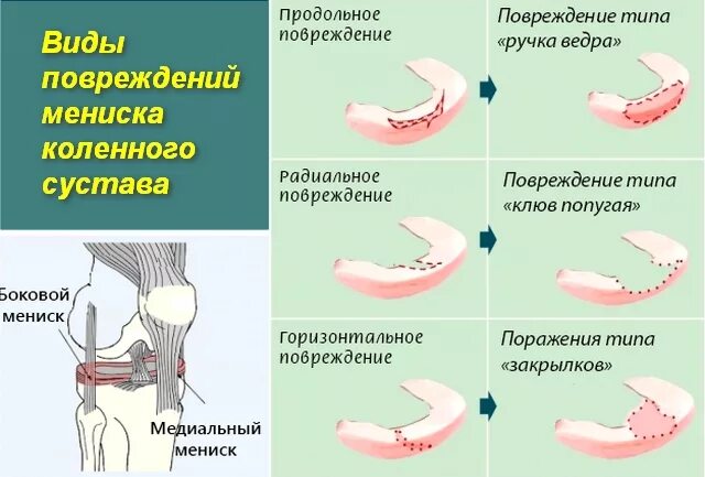 Разрыв мениска код. Симптомы поврежденного мениска. Разрыв мениска коленного сустава симптомы. Симптомы поражения мениска коленного.