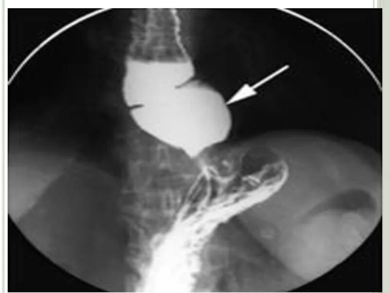 Скопия пищевода. Грыжа диафрагмы пищевода рентген. Аксиальная хиатальная грыжа. Грыжа пищеводного отверстия диафрагмы рентген. Кардиальная грыжа пищеводного отверстия.