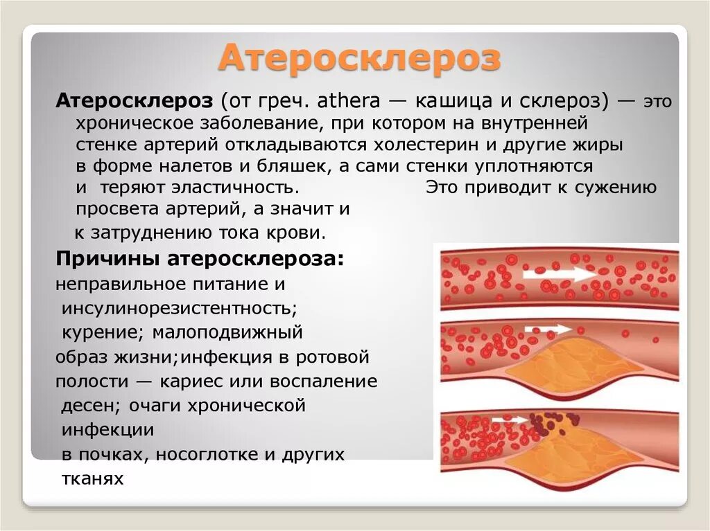 Атеросклероз бляшки сосудов. Атеросклеротическое поражение артерий. Атеросклероз что это за болезнь простыми словами