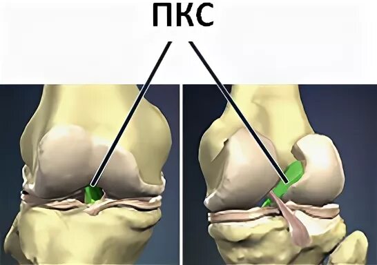 Разрыв связок коленного сустава ПКС операция. Разрыв крестообразной связки коленного сустава. Операция пластика крестообразной связки. Пластика ПКС коленного сустава. Операция колено пкс