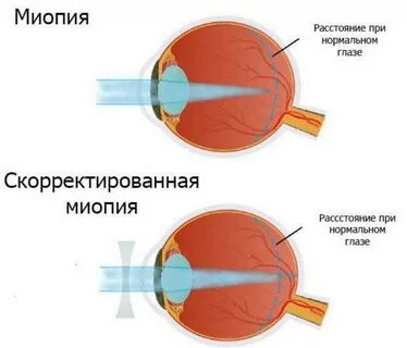 Миопия средней степени h 52.1