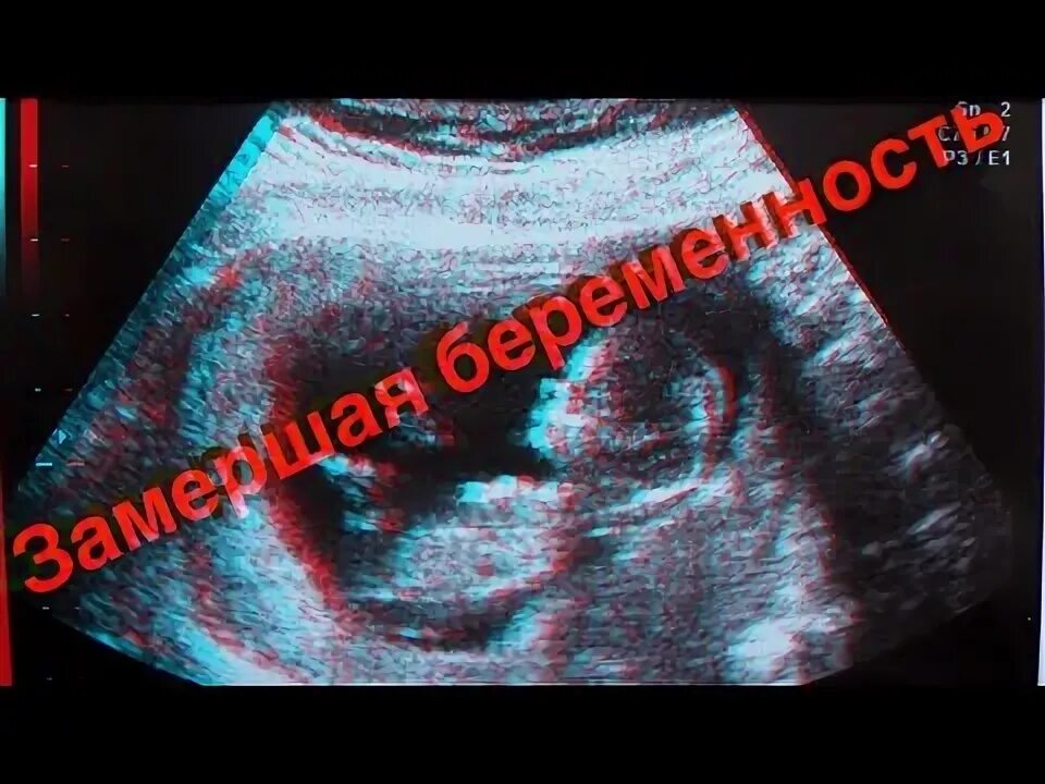 Замершая беременность на раннем сроке. Замершая беременность фото. Неразвивающаяся беременность. Замершая беременность 18 недель
