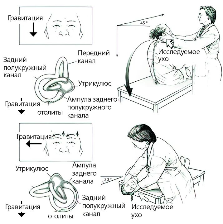 ДППГ доброкачественное пароксизмальное позиционное. Доброкачественное пароксизмальное позиционное головокружение. Проба Дикса Холпайка при ДППГ. ДППГ пробы позиционные.