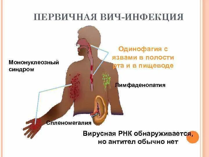 Сыпь на коже при ВИЧ инфекции.