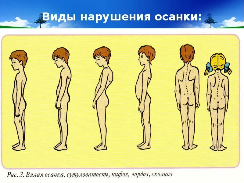 Нарушение осанки у детей. Нарушение осанки. нарушения осанки у детей. виды нарушения осанки. классификация нарушений осанки у детей.