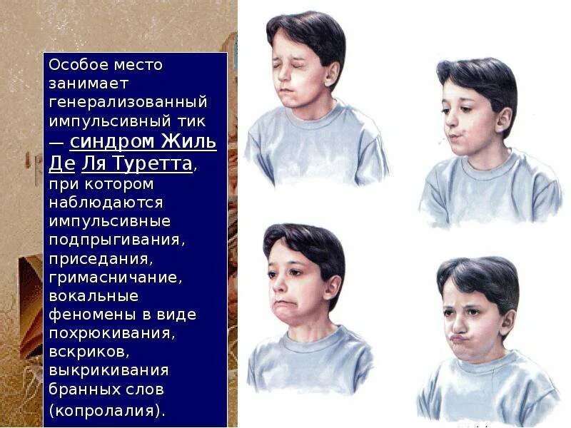 Синдром т. Синдром туретта. генерализованный тик жиль де ля туретта.