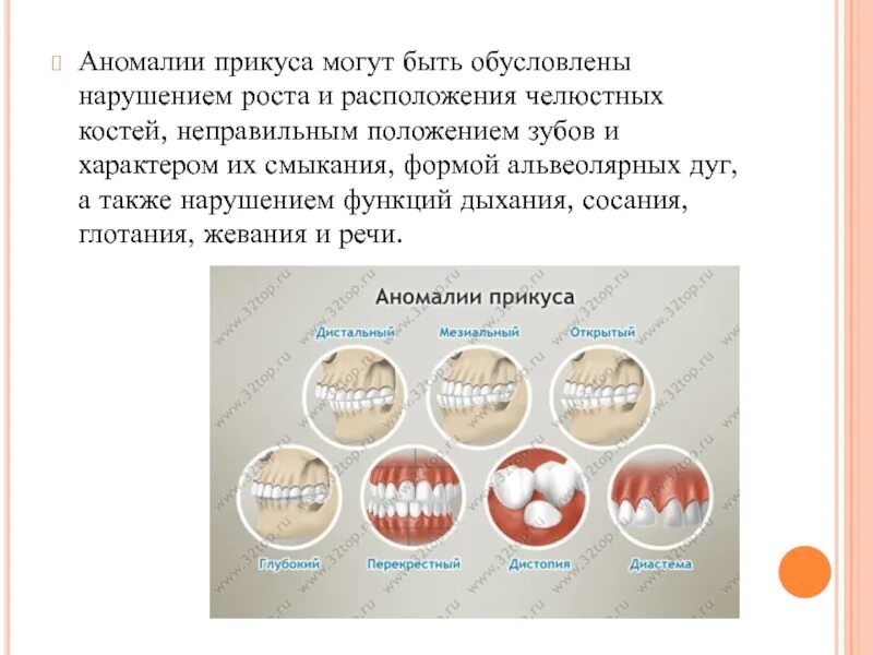 Факторы возникновения зубочелюстных аномалий. Аномальное положение зубов. Классификация неправильного положения зубов. Классификация аномалий развития зубов.