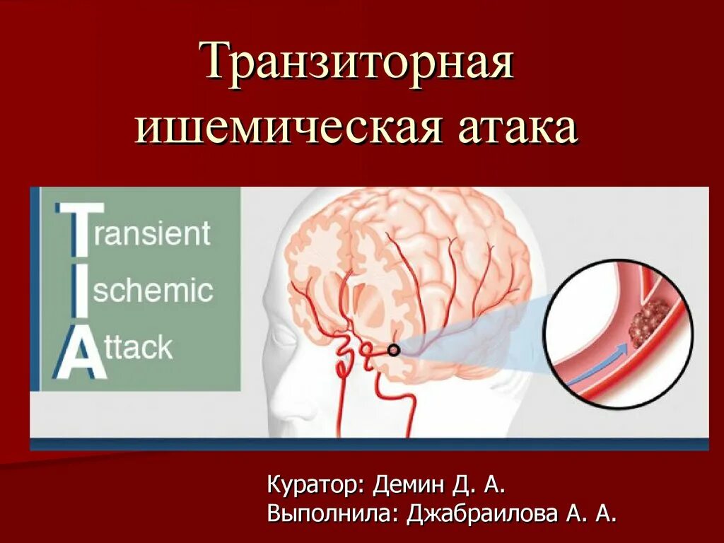 Транзиторная ишемия. Тромбо ишемическая атака. Транзиторные ишемические атаки. Транзиторноишимическая атака. Торзитарно ишемическая атака.