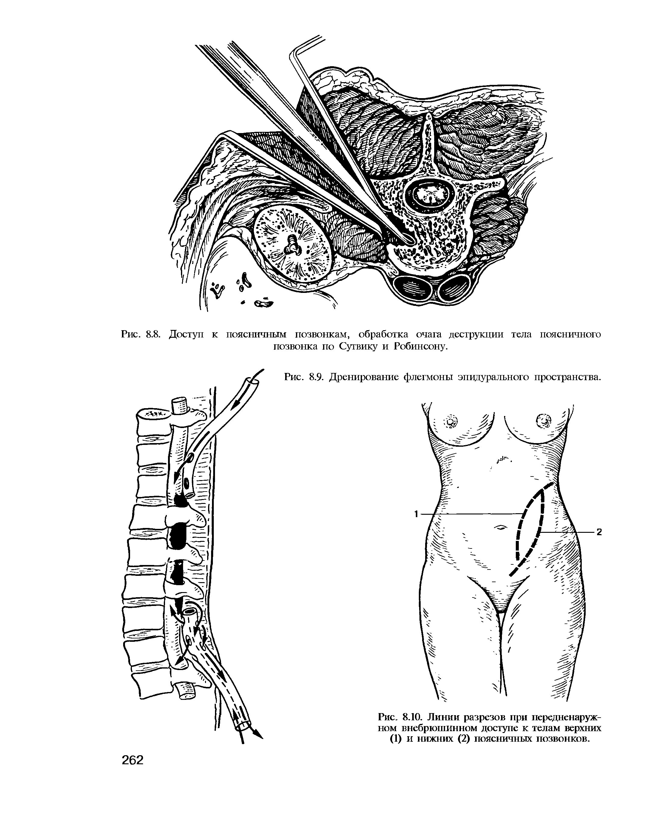 Флегмонозный аппендицит лапароскопия. Операционный разрез. Операционный разрез. Оперативные доступы к почкам и мочеточникам. Грыжесечение бедренной грыжи.