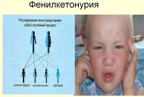 Фенилкетонурия это