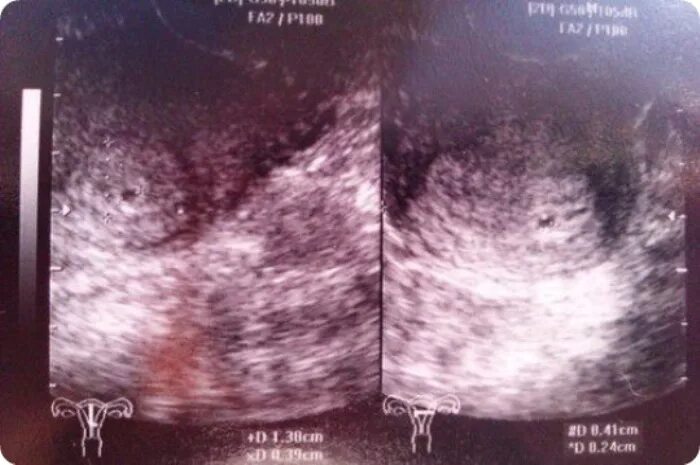Эмбрион на 2 неделе беременности. УЗИ две недели беременности. УЗИ 1-2 недели беременности.