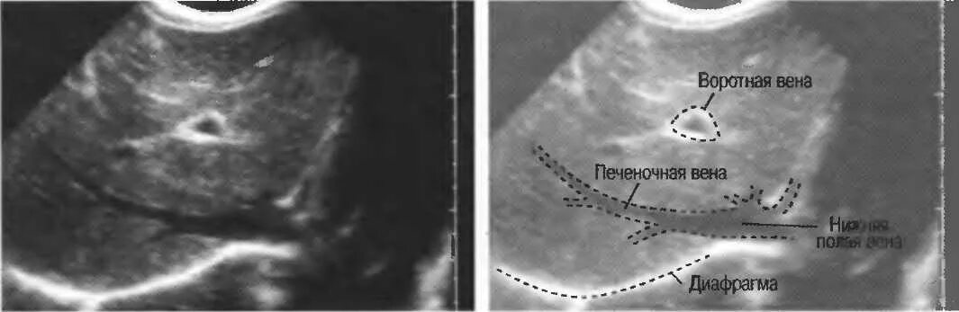 Воротная Вена на УЗИ норма. Воротная Вена печени на УЗИ. Расширение воротной вены на УЗИ. УЗИ печени воротная Вена норма. Расширение селезеночной вены