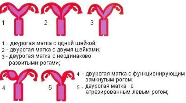 Что такое двурогая матка. Седловидная матка с неполной перегородкой. Двурогая седловидная матка. Форма матки.