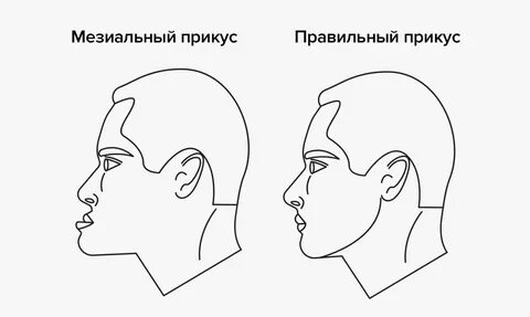Мезиальный прикус