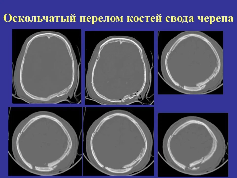 Оскольчатый перелом черепа. Перелом костей свода черепа на кт. перелом свода черепа кт. оскольчатый перелом черепа кт. оскольчатый перелом костей черепа.