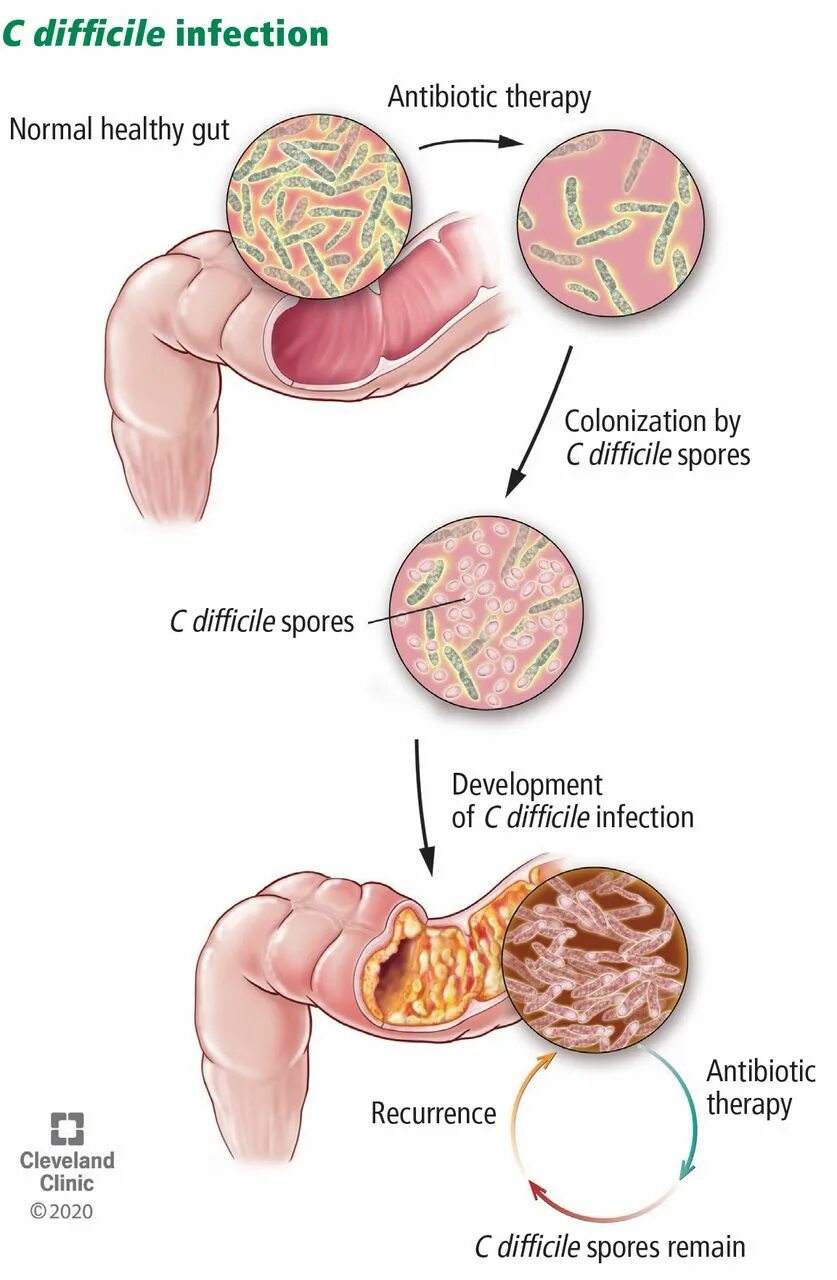 Clostridium difficile антибиотики.